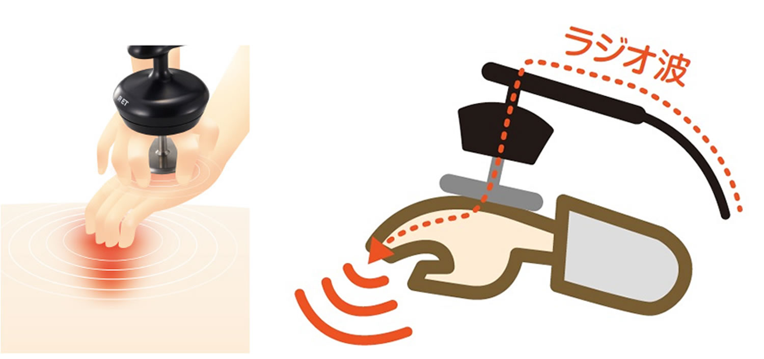 業務用エステ機器はラジオ波